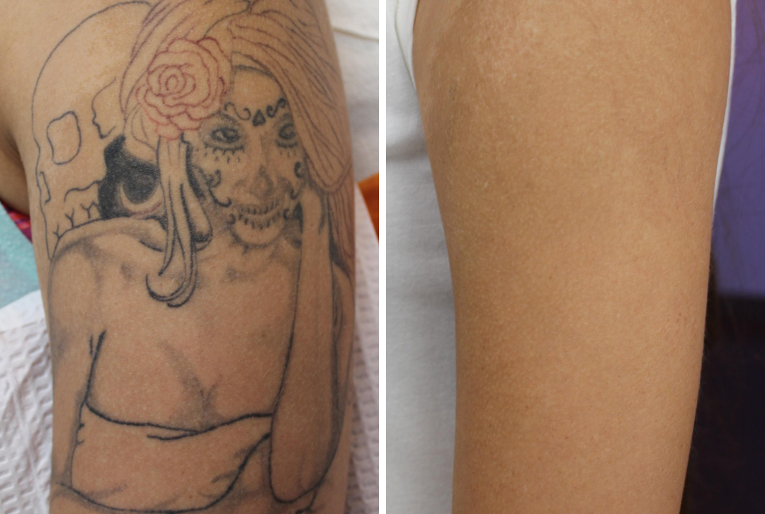 Delete Tattoo Removal patents innovative new treatment - AZ Big Media
